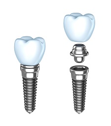Dental Implant Construction | Randolph Family Dentistry in Randolph, MA 